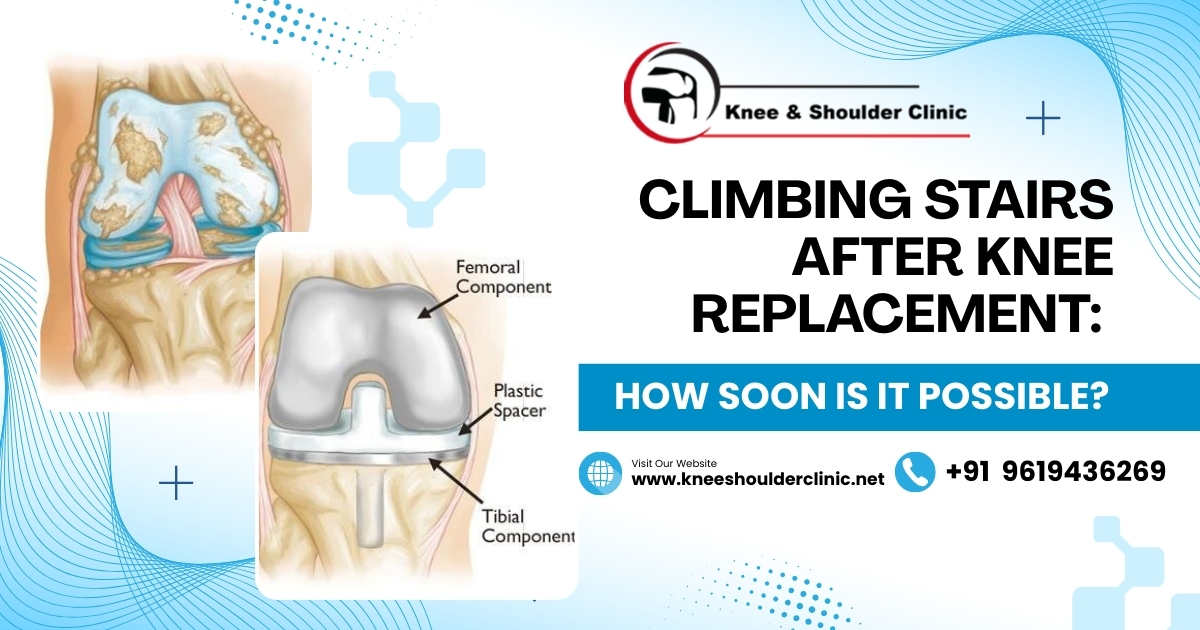 Climbing Stairs After Knee Replacement: How Soon Is It Possible?