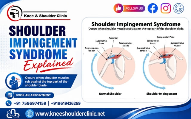 Shoulder Impingement Syndrome Explained